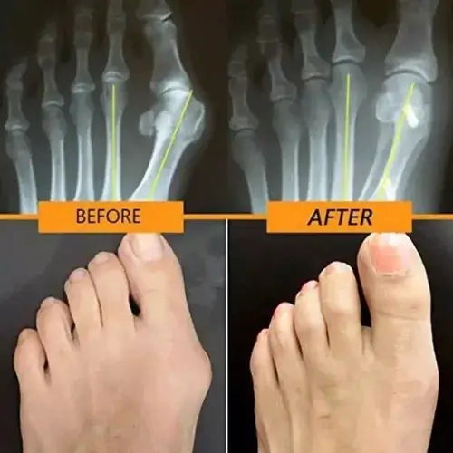 Corrector de Juanetes con Gel Interno